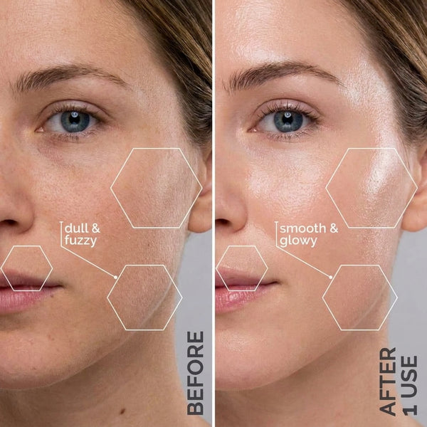Before and after one Sonic Dermaplaner Pro use: dull and fuzzy skin transformed to smooth and glowy